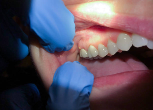 Best Broken or Cracked Tooth Emergency Dentist in Ashland, NE